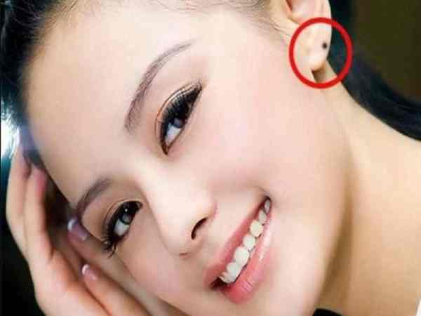 Nốt ruồi nằm trên tai phải
