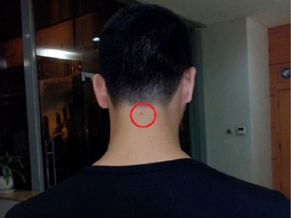 Nốt ruồi sau gáy đàn ông nói lên điều gì?