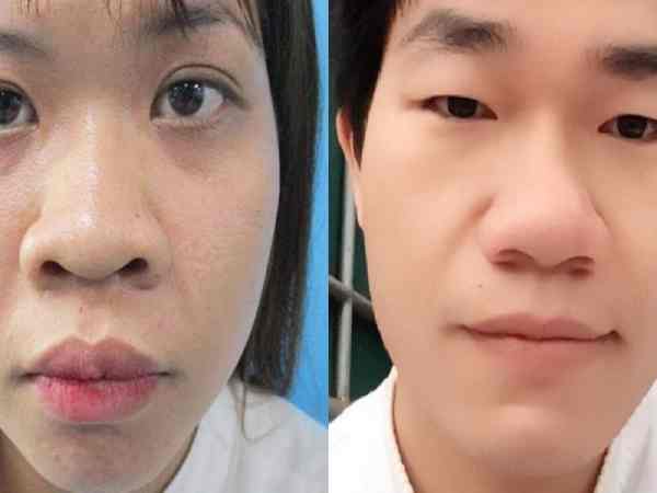 Mũi to, tròn đầy