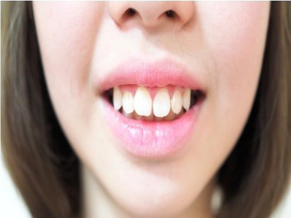 Xem tướng răng hô đoán vận mệnh, tính cách con người