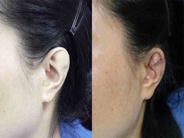 Phụ nữ sở hữu tai chuột thì sao?