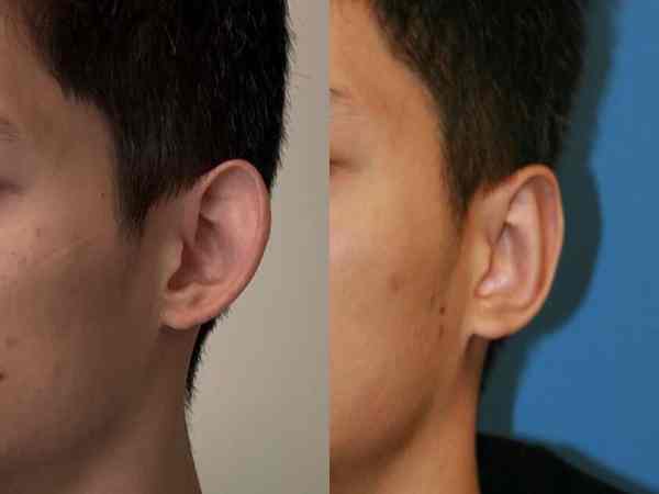 Xem tướng Tai vểnh lên trên
