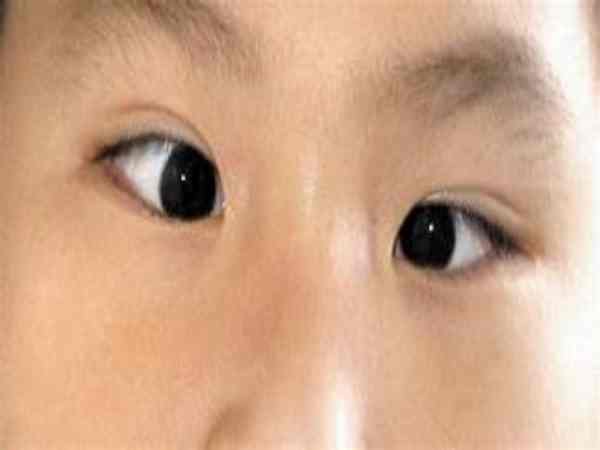 Tướng mắt lé là gì?