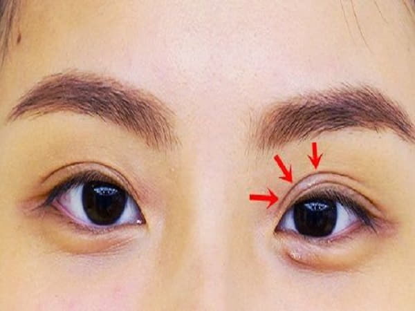 Mắt nhiều mí là gì?