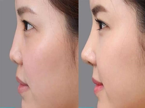 Tướng mũi xấu có dáng mũi (mũi cà chua)