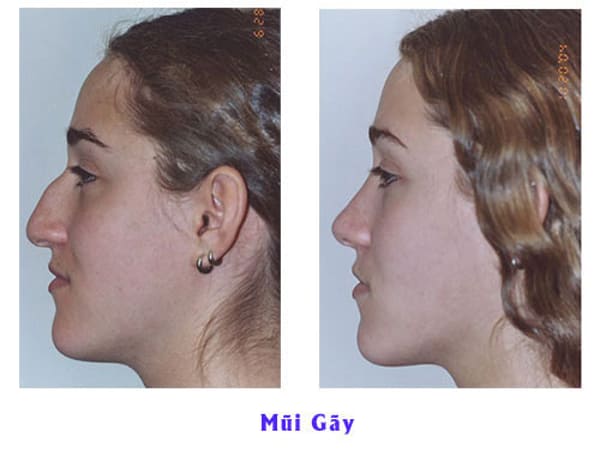 Vận số và cuộc sống người sở hữu mũi gãy