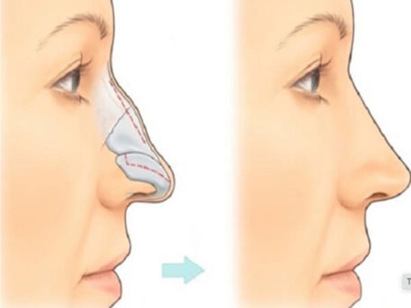 Đặc điểm tướng mũi gãy là gì?