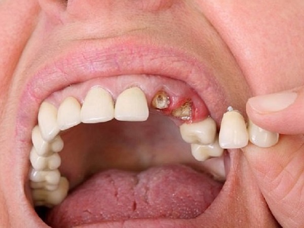 Nằm mơ thấy bị rụng răng là điềm gì, dữ hay lành?