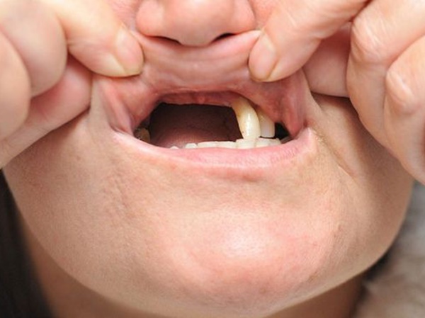 Nằm mơ thấy bị rụng răng là điềm gì, dữ hay lành?